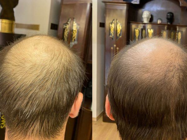 ReHair by iBrows